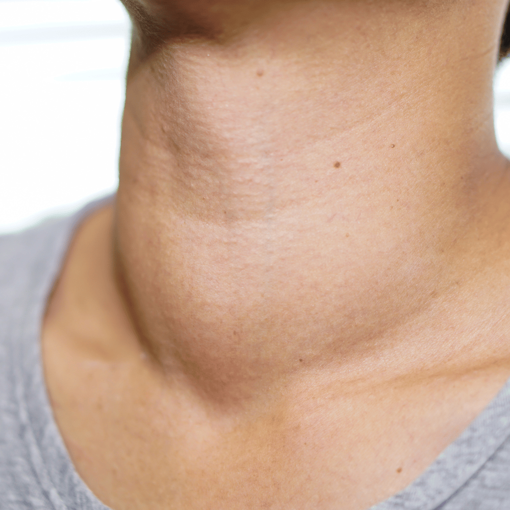 Male Hyperthyroidism