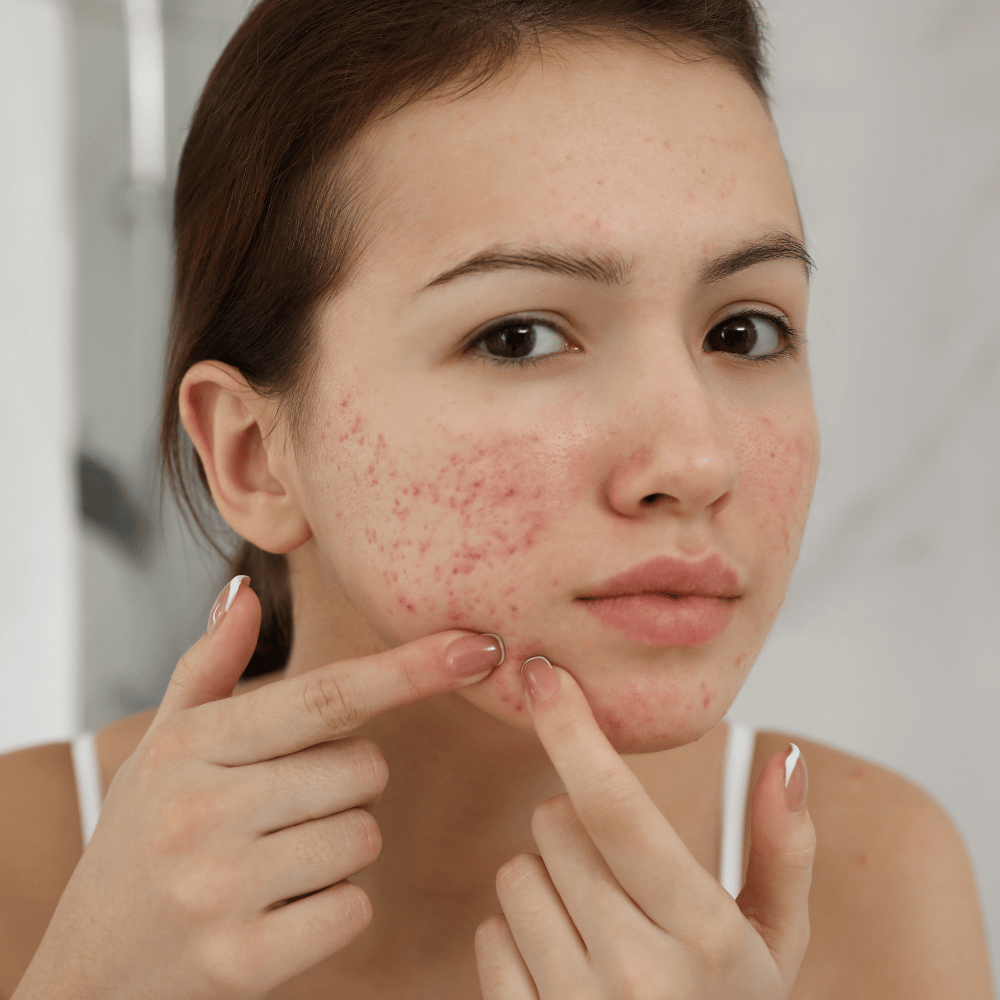 Female Acne