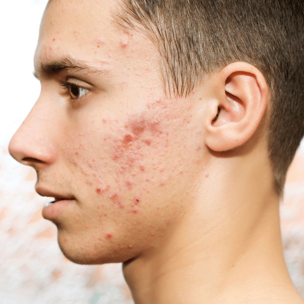 Male Acne