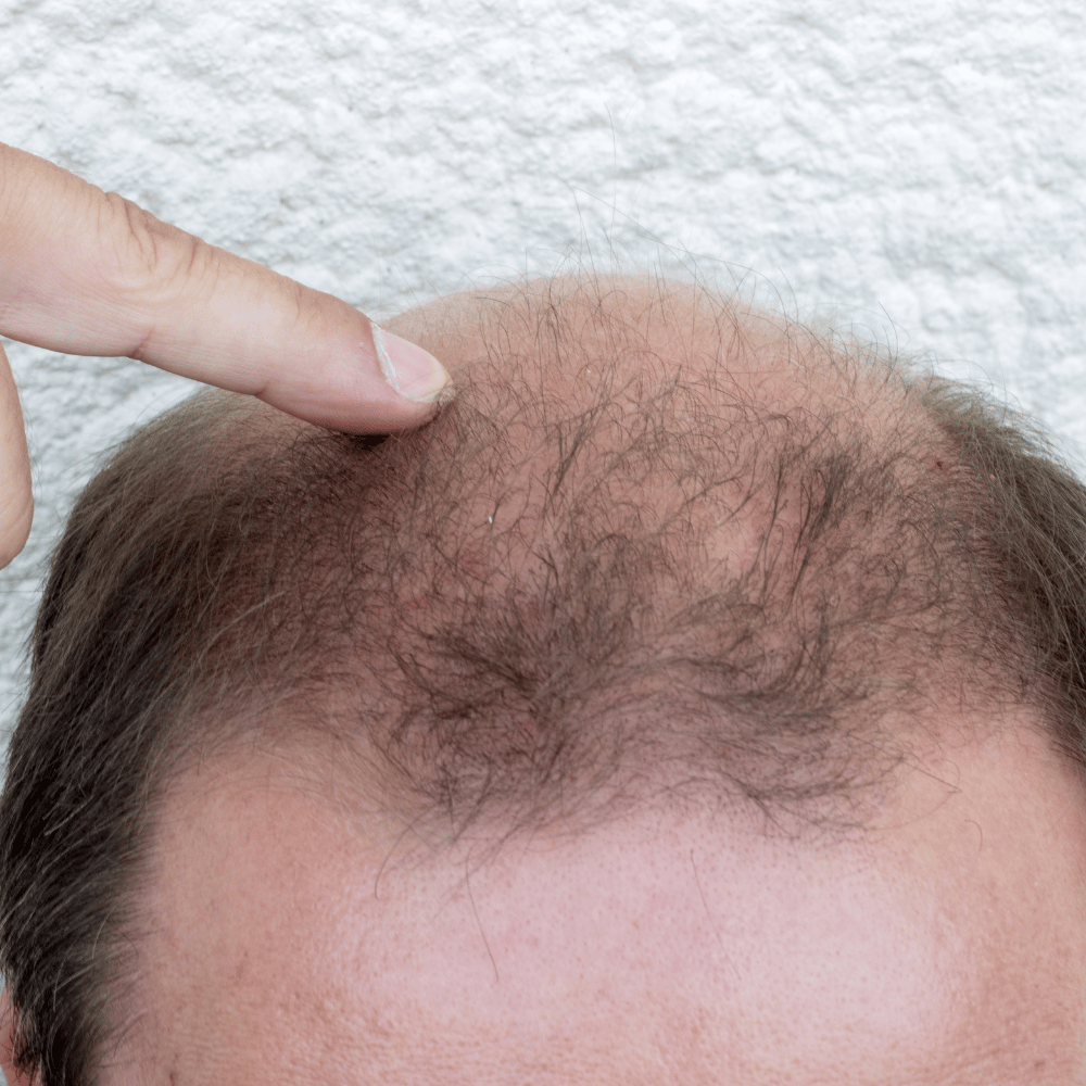 Male Hair Fall